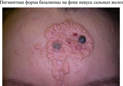 Nevus glandele sebacee cauzate de jadassona, simptome și tratament la nou-născuți