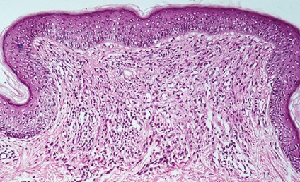 Nevus glandele sebacee cauzate de jadassona, simptome și tratament la nou-născuți