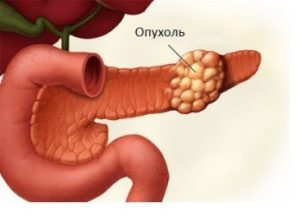 Operație pe pancreas (rezecție)