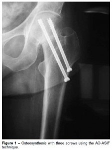 Tipuri de osteosinteză și metode, indicații și contraindicații osteosinteza femurului, colului femural,