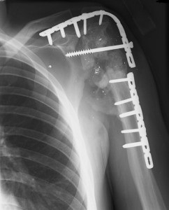 Tipuri de osteosinteză și metode, indicații și contraindicații osteosinteza femurului, colului femural,