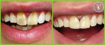 Tooth Whitening hidrogén-peroxiddal a hazai vélemények