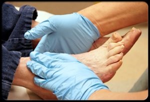 Umflarea picioarelor cu diabet zaharat ce să facă și cum să le tratezi