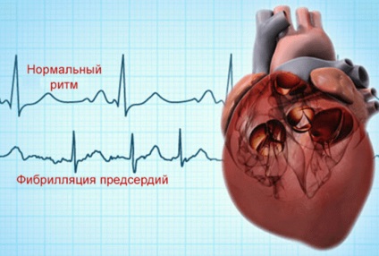 Forma paroxistică de fibrilație atrială și tratamentul de urgență