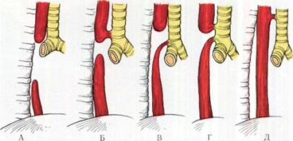 Fistula esofagiană-traheală