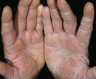 De ce pielea mâinilor se desprinde și crăpa, ce să facă cu ea