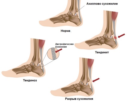 De ce un bărbat tind să aibă un tendon peste călcâiul cauzei, ce să facă