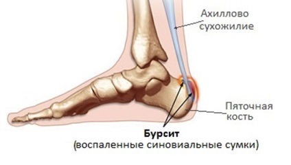 De ce un bărbat tind să aibă un tendon peste călcâiul cauzei, ce să facă