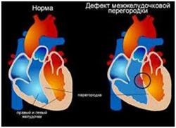 Boala cardiacă la nou-născuți