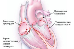 Consecințele aritmiei cardiace