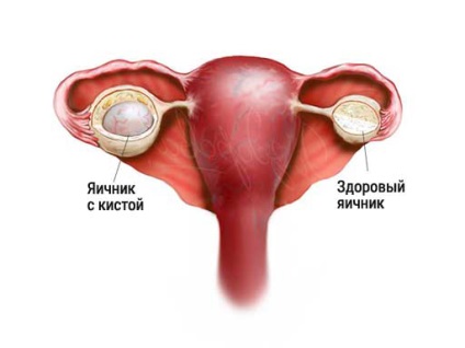 Consecințele chistului ovarian