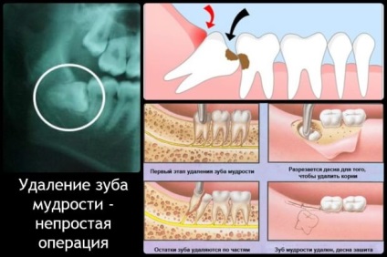 După îndepărtarea dintelui, gingia doare ce trebuie să facă, cât timp, umflat și pregătirile
