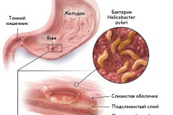 Az okok az éhes gyomorfájás