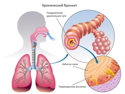 Cauze de gust de sânge în gură la bărbați și femei, inclusiv în dimineața