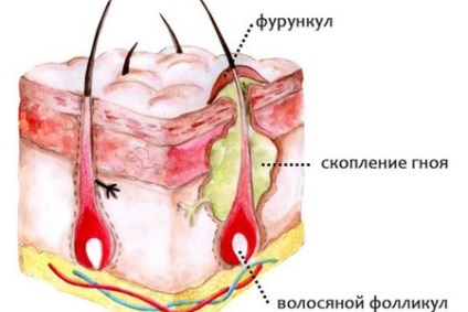 Acnee pe tipurile de penis, cauzele și tratamentul erupțiilor cutanate