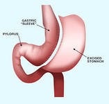 Gastrectomia longitudinală (- scurgere - rezecție, rezecția gastrică a stomacului)