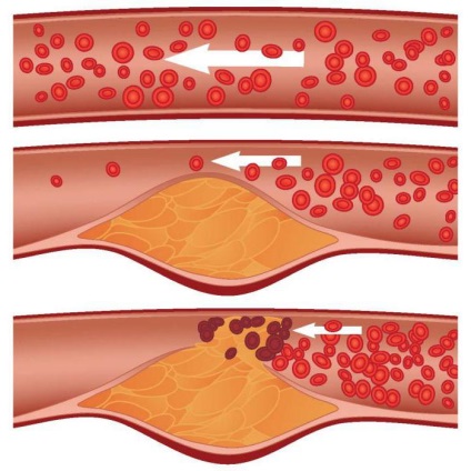 Lipidperoxidáció termékek