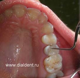 Prognoza vieții de dinți depoluți