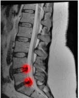 Dezvoltarea protuberanței spinării, diagnosticarea și tratamentul bolii