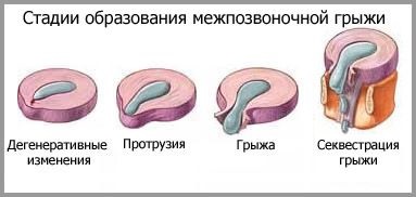 гръбначния издатина на развитие, диагностика и лечение на заболяване