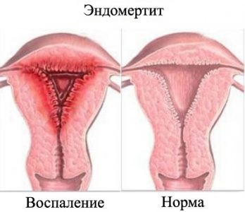 Transparență (mucoasă) la femeile din cauzele și tratamentul vaginului