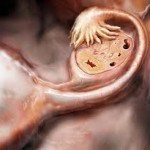 Cancerul ovarian la tratamentul și prognosticul femeilor