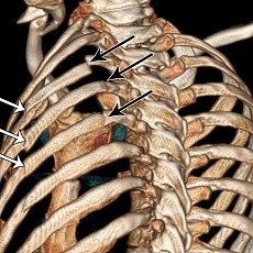 Stretching al tratamentului mușchiului coapsei și simptomele de întindere a cvadricepsului, online sănătoase