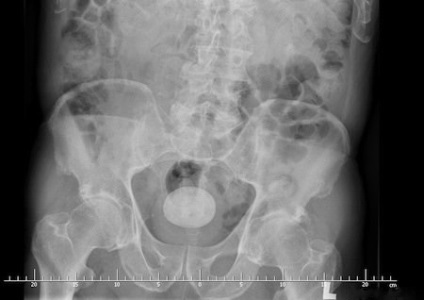 X-ray la începutul sarcinii