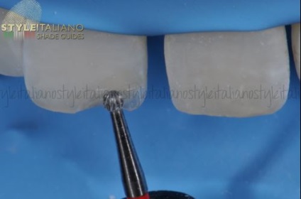 Helyreállítása középső metszőfog szilikon kulcs (mock-up)