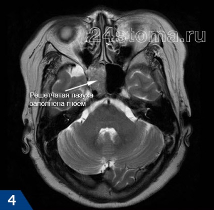 Sphenoiditis tünetek és a kezelés, fogászat