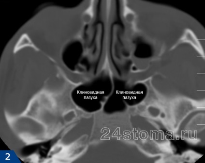 Sphenoiditis tünetek és a kezelés, fogászat