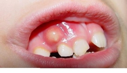 Conuri pe gingia copilului de deasupra dintelui, alb purulent, ce să facă