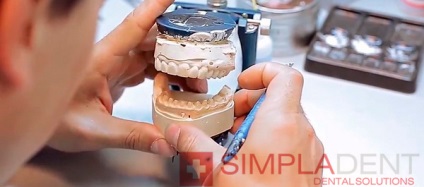 Simpladent echipamente și tehnologie, simplalab, proteze dentare, coroane dentare, implant root in
