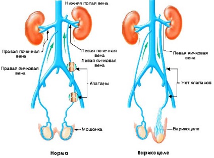 Tünetei a varicocele, ennek mértékét a fejlesztési