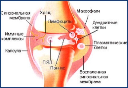 Synovitis a térd tünetek és a kezelés