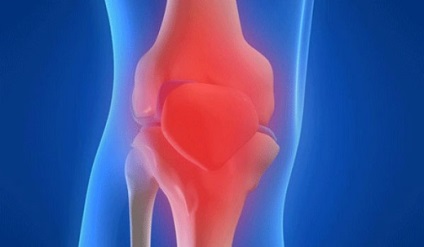 Synovita simptomelor articulare ale genunchiului și tratament