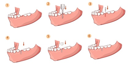 Modern fogászati ​​implantátumokat Moszkva - a legmodernebb módszerek és technikák a fogászati ​​implantátumok