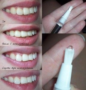 Preparate de dinți pentru albirea dinților în geluri de farmacii și alte preparate