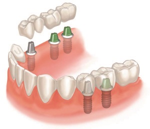 Akár 2 implantátumot 1 foghoz 2 db implantátumot adnak 1 foghoz kedvező áron, fogászati ​​hatás