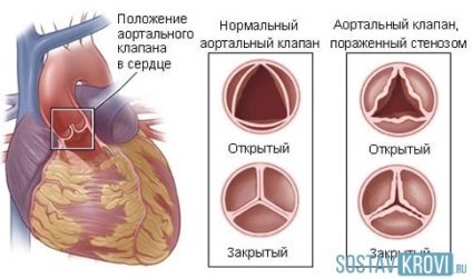 Stenoza simptomelor valvelor aortice, tratament, chirurgie, la nou-născuți, copii, adulți
