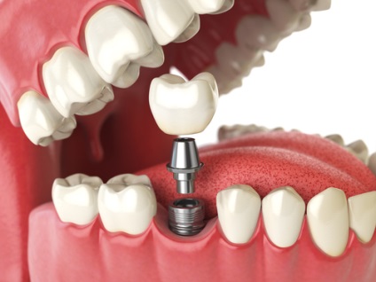 Dental policlinica № 51 - implantologie