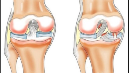 Genunchiere, anatomia ligamentului propriu, transversal, lateral, popliteal