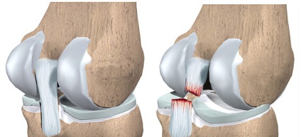 Genunchiere, anatomia ligamentului propriu, transversal, lateral, popliteal