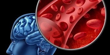 Temperatura la cursa cauzei cresterii, metodele de reducere a temperaturii cu accident vascular cerebral, on-line sanatos