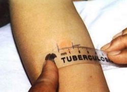 Testul tuberculinei