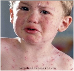 Chicken Pox