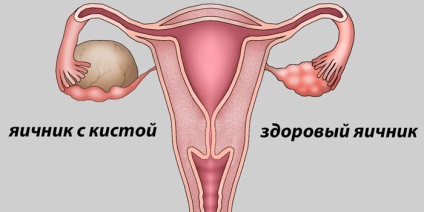 Excrețiile chistului ovarian - semne și simptome ale bolii la femei
