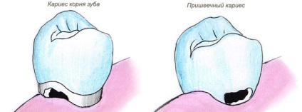 Típusai fogszuvasodás kezelés, fotó, fogászat Moszkvában a kijevi