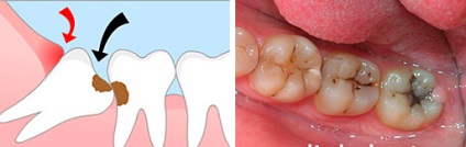 Tipuri de tratament pentru carii dentare, fotografie, stomatologie la Kiev, Moscova