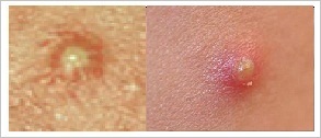 Tipuri de acnee